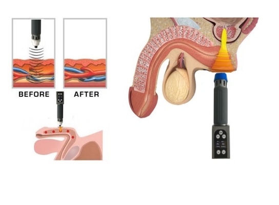 คลินิกใช้เครื่องบำบัดด้วย ESWT แบบ Dual Channel สำหรับการนวดตัวเต็ม ED Treatment